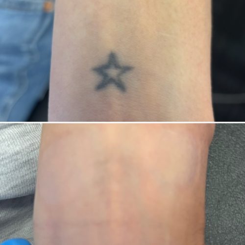 before and after laser tattoo removal