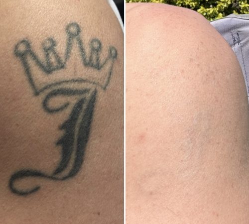laser tattoo removal