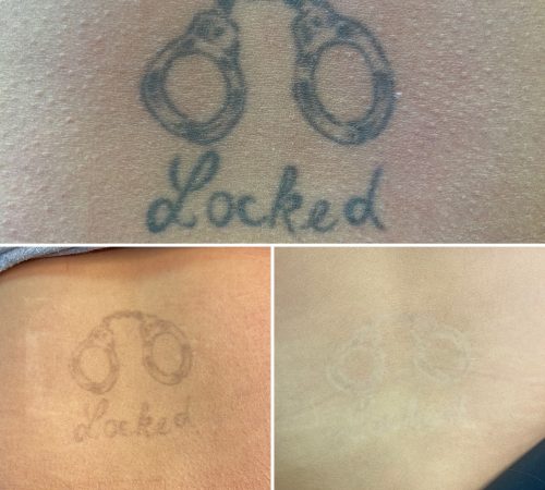 Laser tattoo removal