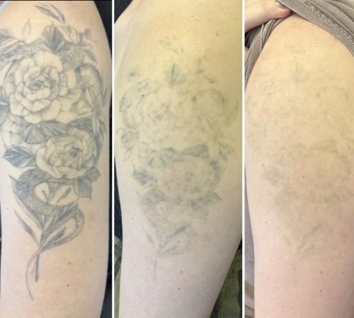 tattoo removal