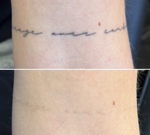 remove my tattoo, laser tattoo removal