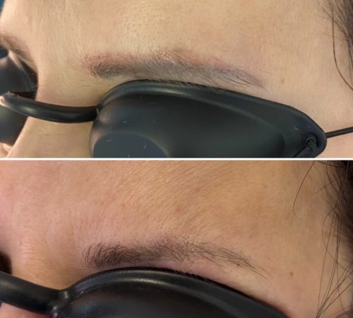 laseer tattoo removal before and after