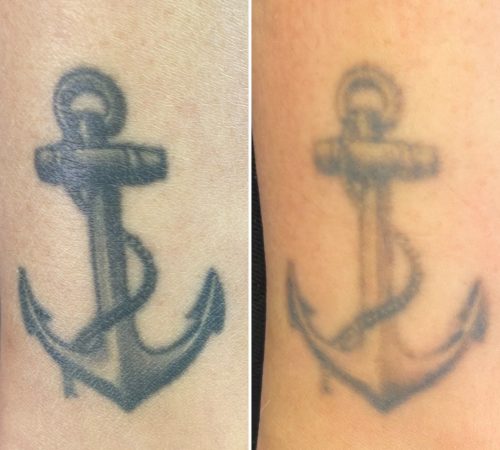 laser tattoo removal