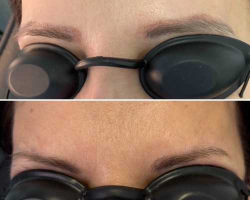 remove my tattoo pmu removal