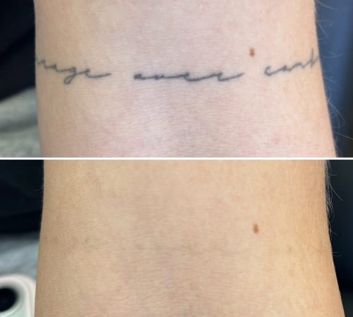 before and after remove my tattoo