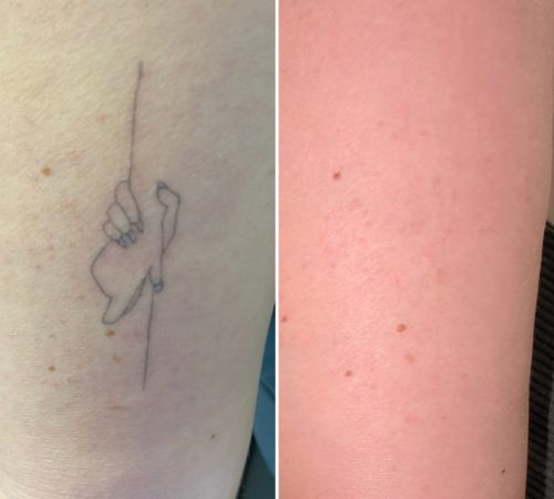 remove my tattoo