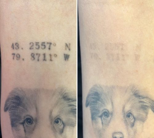 laser tattoo removal , remove my tattoo