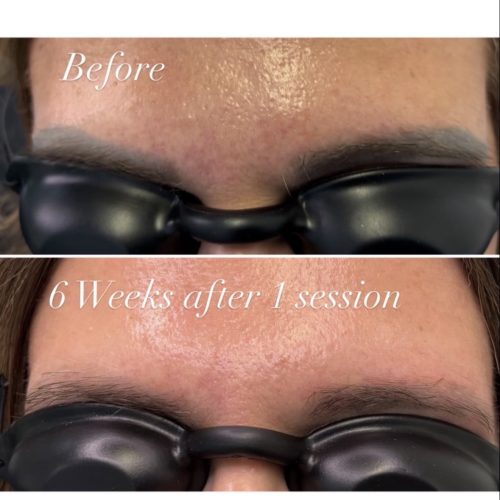 permanent makeup removal