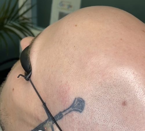 Laser Tattoo Removal
