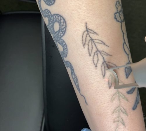 laser tattoo removal