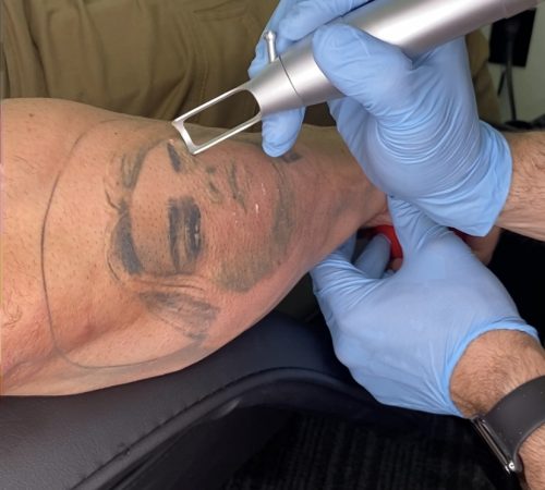 laser tattoo removal