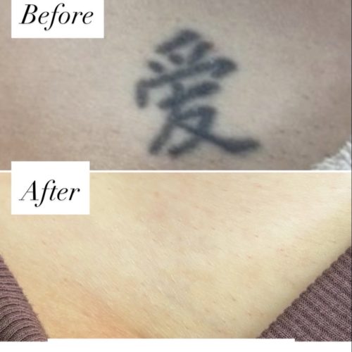 tattoo removal